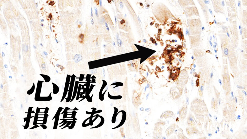 研究者らが新型コロナワクチンと死の関連性を示す【フロントライン・ヘルス】